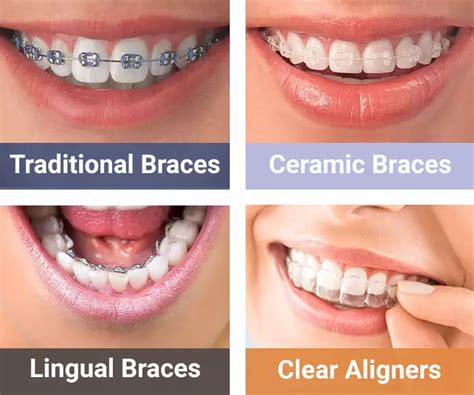 ceramic brackets with metal wire|types of braces ceramic brackets.